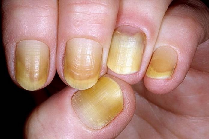 Nails Colour Indicates Health Problems